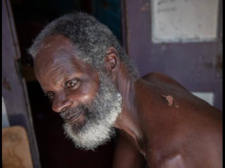 Clayton Wright, 63, shows a burn to his back while seated on the verandah of his neighbour’s home on West Avenue, central Kingston, on Sunday. Wright’s neighbour’s kindness has provided refuge until alternative living arrangements can be organised.