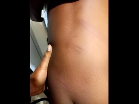 Shaneka Lemord shows the fading welts on the back of her two-year-old son.