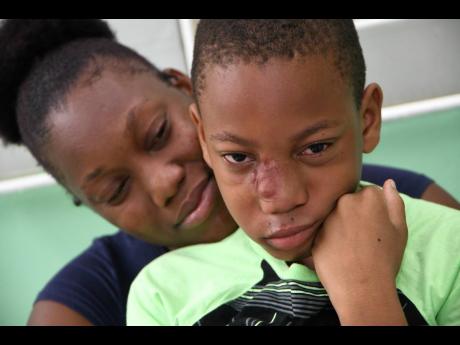 Susan Gordon comforts her son, Jabari Osborne, who has a rare condition, arteriovenous malformation, a growth on his face that was complicated after a bullying incident. 