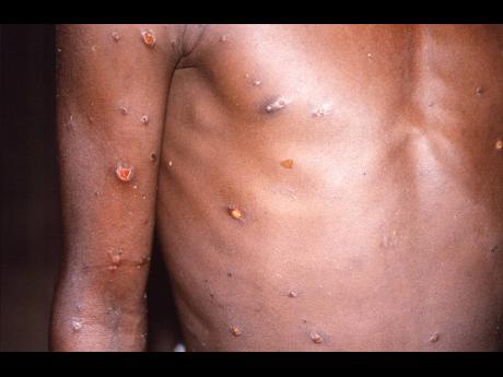 A file image provided by US Centers for Disease Control and Prevention shows the right arm and torso of a patient, whose skin displayed a number of lesions due to what had been an active case of monkeypox.