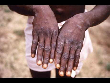 Since the global outbreak, Jamaica’s Ministry of Health and Wellness has sought to educate persons about monkeypox, described as a rare disease. Similar to smallpox, it can be transmitted by contact or droplet exposure. Symptoms of monkeypox include a ra