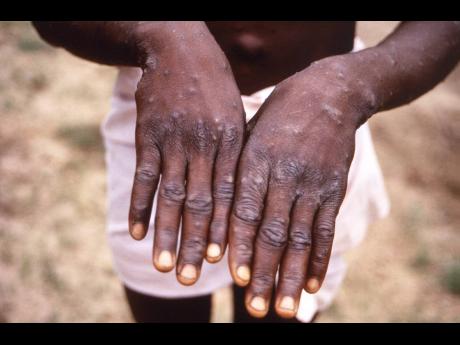 This 1997 image provided by the CDC shows the hands of a patient with monkeypox.