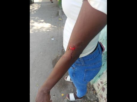 A resident shows a wound she allegedly received after being hit with a rifle by a policeman on Tuesday.